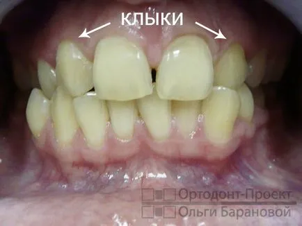 Innovatív megközelítések eltávolítható fogszabályozó kezelés a fogak