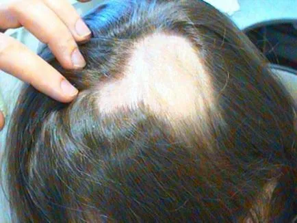 Alopecia cauze, tipuri, metode de tratament