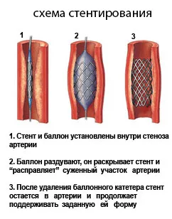 Операции в каротидната артерия стеноза, плаки, атеросклероза