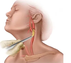 Operațiuni în stenoza arterei carotide, placa, ateroscleroza