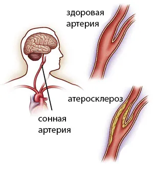 Операции в каротидната артерия стеноза, плаки, атеросклероза