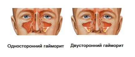 Одонтогенен синузит вид, причините (счупен зъб и т.н.