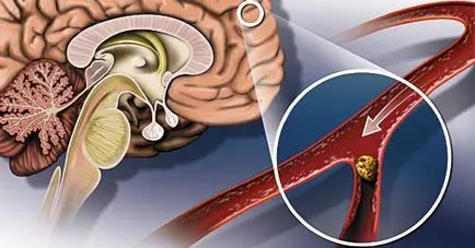 Chirurgie pe arterele carotide - pentru endarterectomia carotidei pentru placi aterosclerotice