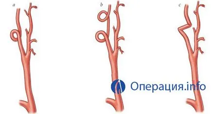 Операции в каротидната артерия стеноза, плаки, атеросклероза