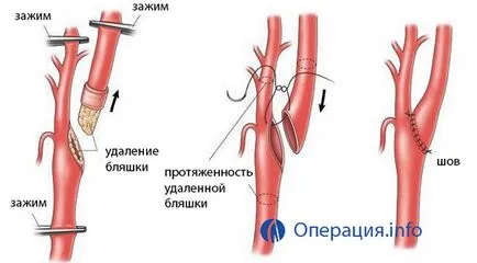 Операции в каротидната артерия стеноза, плаки, атеросклероза