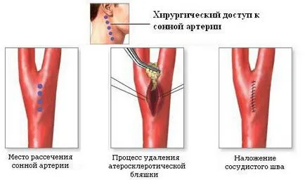 Operațiuni în stenoza arterei carotide, placa, ateroscleroza