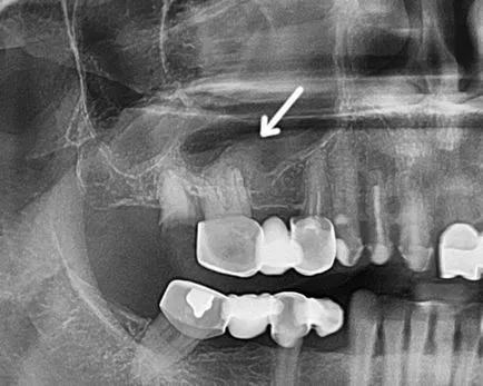 Одонтогенен синузит вид, причините (счупен зъб и т.н.