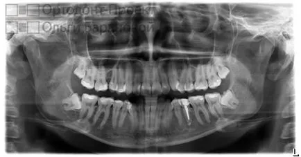 Tratamentul ortodontic dinților cu îndepărtarea - la Ol'ga