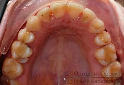 Ортодонтично лечение на зъби с отстраняване - да Ol'ga