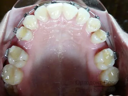 Ортодонтично лечение на зъби с отстраняване - да Ol'ga