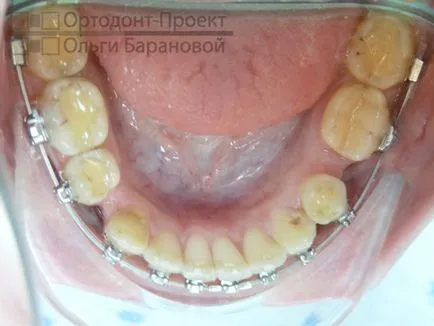 Ортодонтично лечение на зъби с отстраняване - да Ol'ga