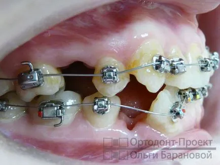 Ортодонтично лечение на зъби с отстраняване - да Ol'ga