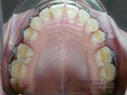 Tratamentul ortodontic dinților cu îndepărtarea - la Ol'ga