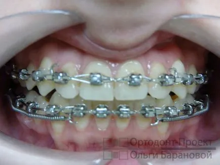 Ортодонтично лечение на зъби с отстраняване - да Ol'ga