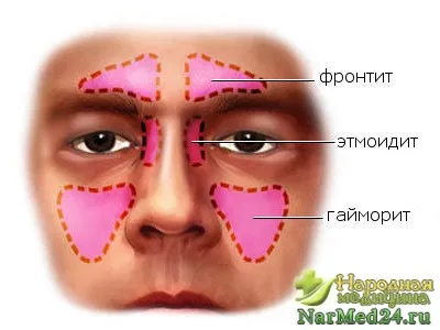 Остър и хроничен синузит при деца и възрастни на симптомите и как да се отнасяме хората средства