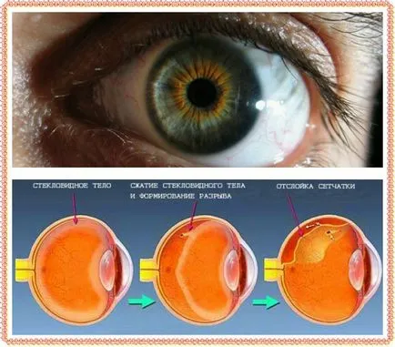 dezlipire de retina Cauzele și un tratament mai bun