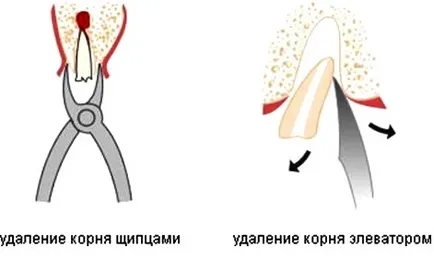 От корена на зъба е само какво да направите, ако сте счупи зъб, стоматология на Киев за Москва