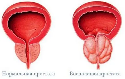 Първите симптоми на простатит и влошаване