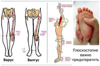 platfus 2 grade; Care sunt simptomele și cum să trateze