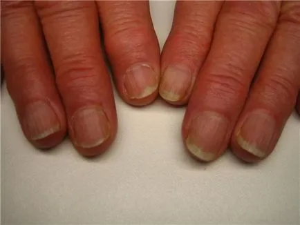 Защо ноктите стават вълнообразни и оребрена