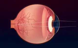 Az első és hátsó ischaemiás optikai neuropátia - okai, tünetei, a hatékony kezelés