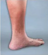 Потъмняване на кожата на крака корици