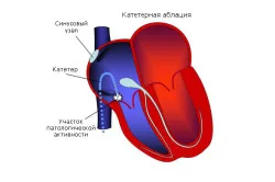 сърдечна обгаряне