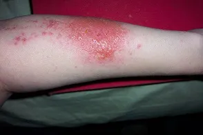 Egyszerű contact dermatitis okai, fotó, tünetei és kezelése, sprosidermatologa