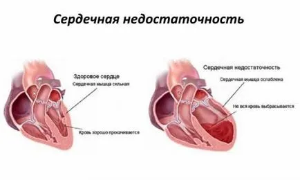 Semne de insuficiență cardiacă în diagnosticul bărbați, ceea ce simptomele la copii