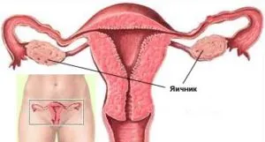 Uterine Cancer Etapa 3 tratamente longevitate