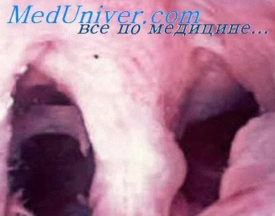 Rata de curgere a fluidului la hysteroresectoscopy