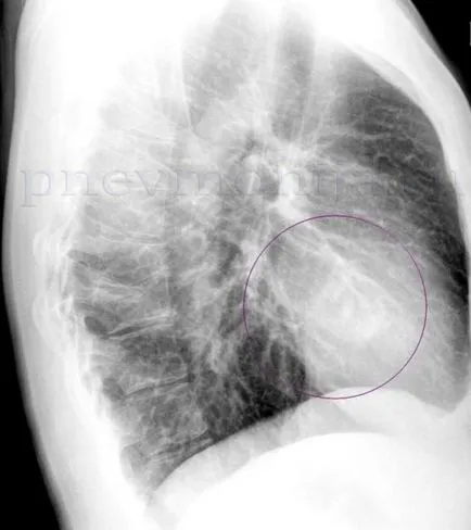 Radiografie toracică în două proiecții care arată etapele