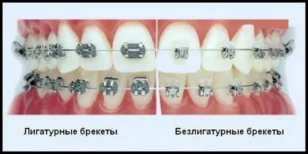 Плюсове и минуси на тиранти митове и реалност, становищата на експерти и пациенти