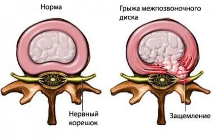 Sergey Bubnovsky doare nici coloanei vertebrale - mușchii în ea