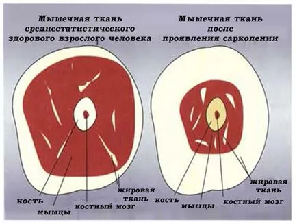 Саркопенията как да се спре загубата на мускулна маса