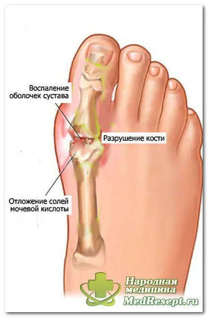 Подутини по палците на краката - малко опасност, застрашаваща сериозни неприятности - медицински