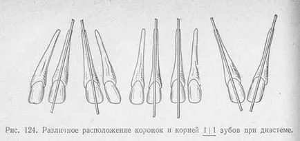 Разстоянието между предните зъби (диастема) как да се отстрани дефекта и правилен Scherbinka