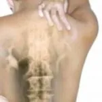 Scolioza a coloanei vertebrale, exerciții de tratament, simptomele