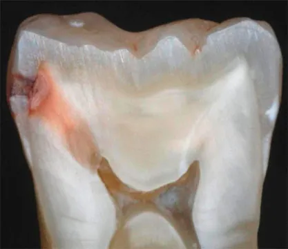 Tünetei a fogszuvasodás, hogyan határozza meg