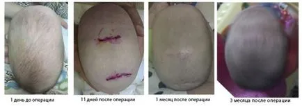 Scaphocephaly okokból, fotók a gyermekek műtét előtt és után, prognózis