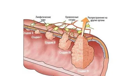Симптоми и признаци на рак на дебелото черво при жените, диагностика и лечение