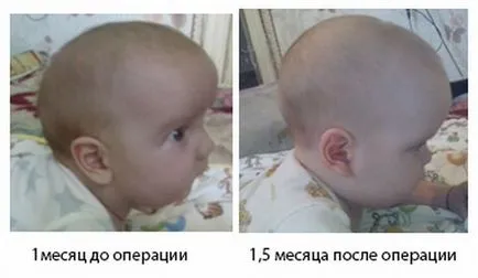 motive Scaphocephaly, fotografii ale copiilor înainte și după o intervenție chirurgicală, prognosticul