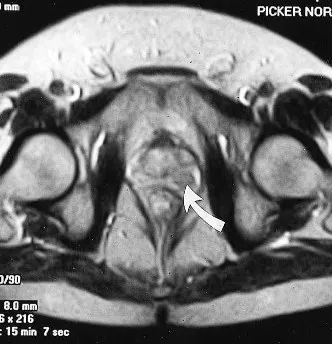 Metode moderne de diagnosticare de prostata