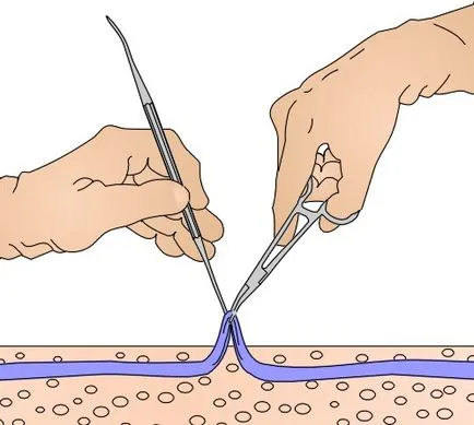Metode moderne de tratament al varicelor fără o intervenție chirurgicală