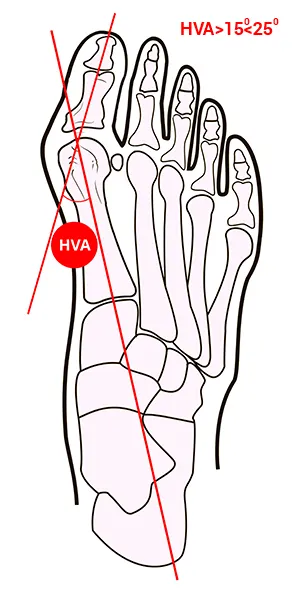 Compararea metodelor de tratament conservator al halux valgus - hallufix România