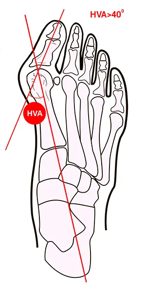 Compararea metodelor de tratament conservator al halux valgus - hallufix România