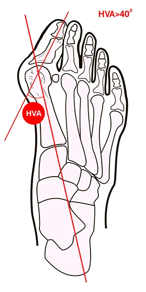 Compararea metodelor de tratament conservator al halux valgus - hallufix România