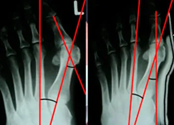 Compararea metodelor de tratament conservator al halux valgus - hallufix România