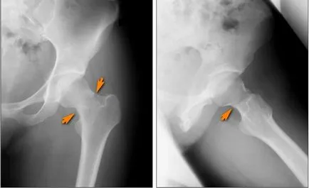 Стрес фрактури (стрес фрактури) на таза и бедрото - и hudoshin