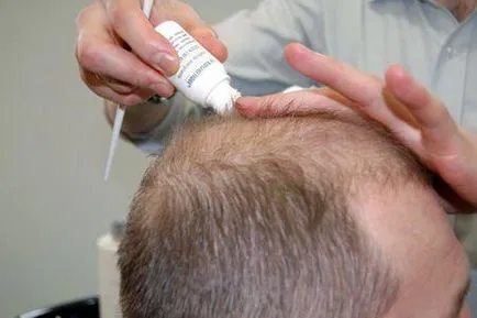 Streptoderma pe cap (păr)